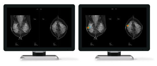 루닛의 유방암 진단 보조 AI 솔루션 '루닛 인사이트 MMG'. 루닛 제공
